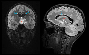 Imagen de RM T2 FLAIR (corte coronal y sagital, respectivamente) que muestra lesión hipotalámica mal definida con obstrucción de tercer ventrículo (*) y moderada prominencia de ventrículos laterales con leve edema transependimario (Δ).