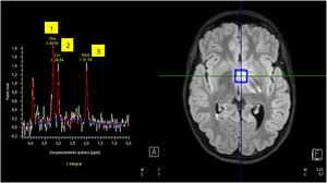 Imagen de RM con espectroscopia que muestra patrón espectroscópico no compatible con tumor cerebral: elevación de colina (1), creatina (2) y NAA (3) obtenido de la lesión a estudio.