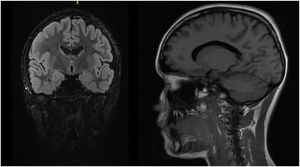 Imagen de RM T2 FLAIR (corte coronal y sagital, respectivamente) que muestra resolución completa de la clínica tras tratamiento corticoideo.