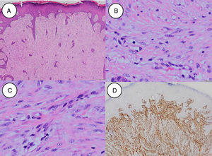 Estudio histológico de la lesión. A) Visión panorámica (tinción con hematoxilina-eosina, 4× aumentos) con proliferación fusocelular que ocupa el espesor completo de la dermis; B) Tinción con hematoxilina-eosina, detalle a mayor aumento (40×) de células fusiformes que componen la lesión; C) Tinción con hematoxilina-eosina, detalle a 40× de cuerpos de inclusión intracelulares y eosinófilos que son patognomónicos; D) Tinción de desmina positiva en la inmunohistoquímica (4×).