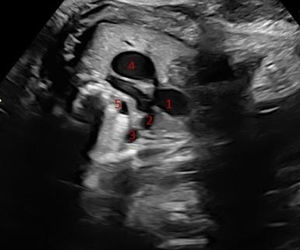 Ecografía prenatal. Modo 2D. Plano tres vasos-tráquea. La «V» que forman Aorta y Pulmonar se sitúa en zona superior e izquierda de la imagen. Se visualiza ductus arterioso con dilatación sacular de aspecto aneurismático, con diámetro transverso de 10mm. Estructuras: 1. Arteria pulmonar; 2. Arteria aorta; 3. Cava Superior; 4. Ductus; 5. Tráquea.