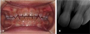 Examen clínico y radiografía del paciente. A)Examen clínico del paciente a los 27meses con la dentición temporal completa. B)Radiografías periapicales del paciente que revelan la obliteración de dos tercios de las cámaras pulpares.