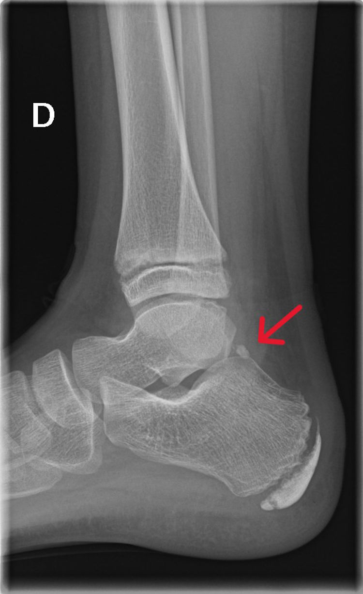 Tobillo Rx Síndrome del pinzamiento posterior del tobillo | Anales de Pediatría
