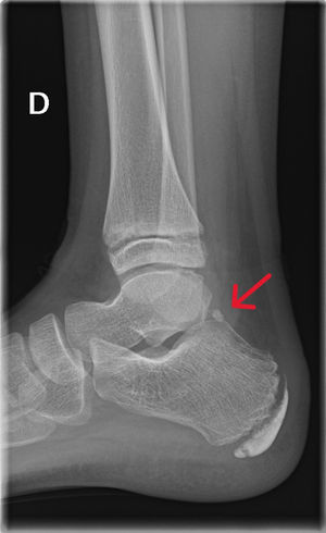 Radiografía lateral de tobillo: se observa hueso accesorio posterior al astrágalo, compatible con variante anatómica, trígono.