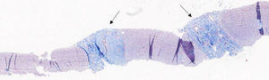 Tricrómico de Masson. Técnica que permite visualizar en azul las fibras de colágeno. Se observa fibrosis de los espacios porta sin formación de puentes fibrosos portoportales (flechas). Grado de fibrosis METAVIR: F1.