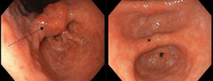 Estómago. Pérdida de patrón vascular y mucoso con zonas eritematosas, mucosa en empedrado a nivel de curvatura menor de estómago y antro. Lesión edematosa y congestiva de 1-2cm compatible con pólipo sésil multilobulado (flecha). Mínima lesión residual tras tratamiento con manosa oral (*).