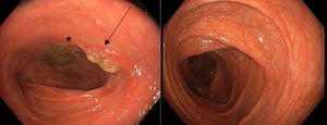 Colon. Mucosa de aspecto edematoso con fibrina asociada, sugestivo de pólipo sésil (flecha) con aftas aisladas alternando con mucosa de aspecto normal (*). Normalización de lesiones endoscópicas tras el inicio de manosa oral.