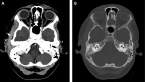 Imagen de TAC. A. Ventana de partes blandas, con contraste endovenoso: mastoiditis derecha con absceso subperióstico temporal de 3,5mm y mínimo trombo no oclusivo en seno sigmoide. Se aprecia aumento asimétrico de partes blandas indicativo de miositis reactiva del músculo temporal. B. Imagen axial en ventana de hueso en la que se percibe retención de secreciones otomastoideas.