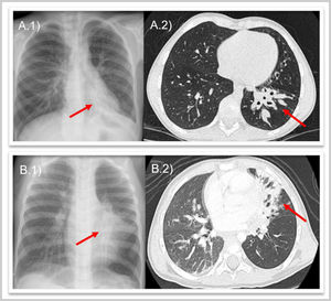 A.1) Caso 1. Radiografía de tórax con atelectasia de lóbulo inferior izquierdo (flecha roja). A.2) Caso 1. Tomografía computarizada con bronquiectasias en lóbulo inferior izquierdo (flecha roja). B.1) Caso 2. Radiografía de tórax con infiltrado paracardíaco izquierdo (flecha roja). B.2) Caso 2. Tomografía computarizada con atelectasia de língula y bronquiectasias (flecha roja).