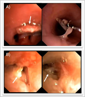 Broncoscopia flexible. A) Caso 1. Cuerpo extraño en segmentos basales de pulmón izquierdo (flecha blanca) y extracción con pinzas. B) Caso 2. Cuerpo extraño en bronquio principal izquierdo (flecha blanca) con importante edema e inflamación de mucosa adyacente.