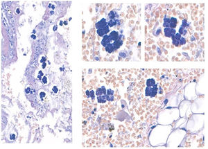 Estudio histológico del espécimen quirúrgico. La tinción con hematoxilina-eosina reveló áreas hemorrágicas difusas con necrosis isquémica extensa de la mucosa y submucosa, así como la presencia de C. ventriculi con características microscópicas típicas: bacterias esféricas (cocos) y basófilas de 1,8 a 3μm de diámetro dispuestas en tétradas u octetos formando agrupaciones cuboideas.