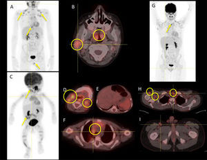 Imágenes de PET/TC con 18F-FDG donde se observan las adenopatías a estudio (nasofaringe, amígdalas y ganglios linfáticos mediastínicos, supraclaviculares, axilares e inguinales) con avidez por el radiofármaco.