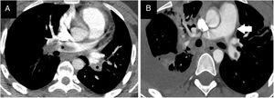 A) Angio-TC donde se aprecia TEP masivo que afecta a ambas ramas pulmonares principales (*). B) Tronco arteria pulmonar (flecha) con calibre aumentado (32mm) como signo de hipertensión pulmonar y sobrecarga del ventrículo derecho.