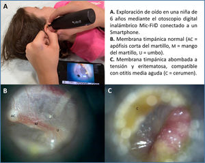 Otoscopia mediante el otoscopio digital Mic-Fi®.