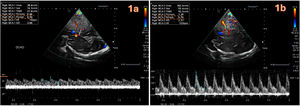 Doppler transcraneal a través de ventana transtemporal a las 18h del ingreso que muestra la asimetría de las velocidades del flujo sanguíneo cerebral entre ambas arterias cerebrales medias (ACM). 1a. ACM derecha: flujos sistólicos y diastólicos mínimos (28 y 14cm/s), indicativos de isquemia. Índice de pulsatilidad (IP) descendido de 0,6 e índice de resistencia (IR) de 0,5. 1b. ACM izquierda: flujos sistólicos elevados (183cm/s), diastólico de 55cm/s con IR (0,7) e IP elevados (1,39), indicativos de hipertensión intracraneal.