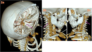 Reconstrucción 3DVR. 2a. Extensa craniectomía descompresiva frontoparietotemporal derecha. Ausencia de visualización de segmento cavernoso y clinoideo de arteria carótida interna (ACI) derecha con leve asimetría de arteria cerebral media y subdivisiones superior e inferior respecto al lado contralateral. 2b. Imagen de stop ACI derecha posbifurcación segmento C2 de morfología afilada con oclusión progresiva («signo de la llama») acorde con disección carotídea. 2c. Trayecto y morfología normal de ACI izquierda.