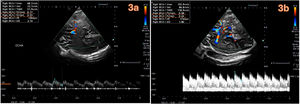 Doppler transcraneal a través de ventana transtemporal a las 96h del ingreso que muestra la discreta mejoría del flujo de la arteria cerebral media (ACM) derecha con normalización de los datos de hipertensión intracraneal. 3a. ACM derecha: flujos sistólicos y diastólicos más elevados pero escasos (68 y 32cm/s). Índice de pulsatilidad (IP) de 0,7 e índice de resistencia (IR) de 0,5. 3b. ACM izquierda: flujos sistólicos normalizados (155cm/s), diastólicos mayores de 86cm/s con IR (0,58) e IP 0,44 normalizados.