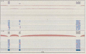 Lecturas que cubren los exones 15, 16 y 17. En la parte superior se observa una combinación de lecturas que soportan la presencia del transcripto habitual, junto con otras que excluyen el exón 16 y empalman el 15 con el 17. En la parte inferior, se presentan resultados de un individuo control, donde solo se observan lecturas que soportan la presencia del transcrito de los 3 exones. Fuente: Extraída del informe de qGenomics.
