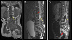 Resonancia magnética prequirúrgica. A) Corte coronal, secuencia T1, masa intrarraquídea hipointensa (flecha amarilla). B) Corte sagital, secuencia T2, masa intrarraquídea hiperintensa en cono medular (flecha amarilla). Destaca hiperintensidad en relación con gran edema en el tramo distal de la médula (flecha roja). C) Corte sagital, secuencia T1 tras la administración de gadolinio. Se observa masa intradural con captación periférica de contraste inmediatamente inferior al cono medular (flecha amarilla), y extensión de la misma a territorio presacro (flecha roja).