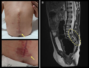 A) Hemangioma lumbar infantil sobre cicatriz posquirúrgica (flechas amarillas). B) Resonancia magnética posquirúrgica. Corte sagital, secuencia T2. Se observa trayecto fistuloso sacrococcígeo en probable relación a seno dérmico (círculo amarillo).