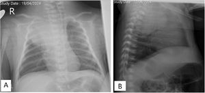 Radiografía de tórax. A)Proyección anteroposterior. Opacidad completa en el lóbulo superior derecho, con desplazamiento mediastínico hacia el lado contralateral, con buena aireación de los demás campos pulmonares, sin derrame pleural asociado. B)Proyección lateral. Opacidad en el segmento posterior del lóbulo superior del pulmón derecho, de morfología nodular.