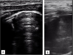 Ecografía torácica realizada con sonda lineal de alta frecuencia. A)Plano longitudinal a nivel de campo pulmonar anterior, superior derecho. Adecuado deslizamiento pleural, buena aireación en todos los campos pulmonares, con patrón de líneas A y puntuación de Brat de 0 puntos. B)Plano supraclavicular derecho. Consolidación sin broncograma aéreo ni captación en el doppler con borde profundo bien definido y redondeado de 6cm de diámetro máximo.