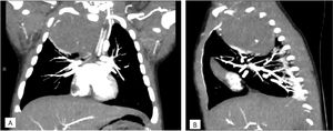 TAC torácica con administración con contraste intravenoso. Masa en mediastino posterior de 4,6×4,3×6,3cm con realce heterogéneo y pequeñas calcificaciones en su interior que ejerce efecto masa desplazando estructuras adyacentes y comprimiendo el lóbulo superior derecho. A)Corte coronal. B)Corte sagital.