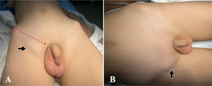 A: Tumoración de aproximadamente 4×3cm (flecha) bajo el área anatómica del ligamento inguinal derecho –esquematizado por la línea discontinua– y lateral al tubérculo púbico (representado por el borde medial de la línea roja). B: Visión frontal de la protrusión, inferior y lateral al canal inguinal, dolorosa, parcialmente reductible y sin signos inflamatorios; compatible con hernia crural o femoral (flecha).