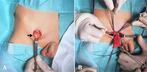 Hallazgos de la cirugía programada realizada 10 días después de la valoración inicial en urgencias. A: Inguinotomía derecha y saco herniario con contenido graso intraperitoneal (flecha), que protruye desde el suelo del canal inguinal a través del anillo femoral, cuyo límite lateral es la vena femoral, medialmente el ligamento lacunar o de Gimbernat, en la parte anterior el ligamento inguinal y posteriormente el ligamento pectíneo o de Cooper. B: Disección del saco e individualización del cuello herniario identificando el defecto del anillo femoral (flecha).