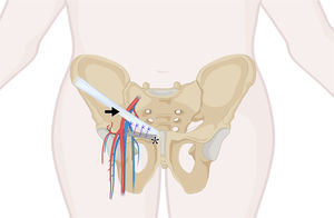 Ilustración de la corrección quirúrgica. Tras reducir el contenido herniario a la cavidad abdominal se realizó una reparación primaria del defecto mediante puntos simples de poliglactina 910 (2-0), afrontando el ligamento de Cooper (*) y el ligamento inguinal (flecha), sin apertura de la fascia del músculo oblicuo externo ni necesidad de material protésico. Cinco meses después de la intervención el paciente se mantiene asintomático. Fuente: Elaboración propia del autor de correspondencia.