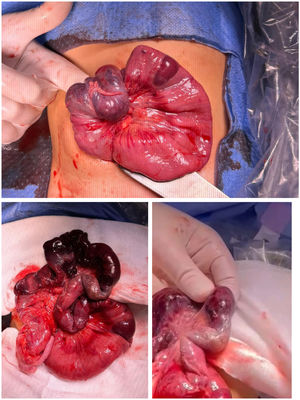 Imágenes intraoperatorias. Superior: invaginación ileocecal. Inferior izquierda: segmento intestinal necrótico. Inferior derecha: lesión redondeada indurada compatible con páncreas heterotópico.