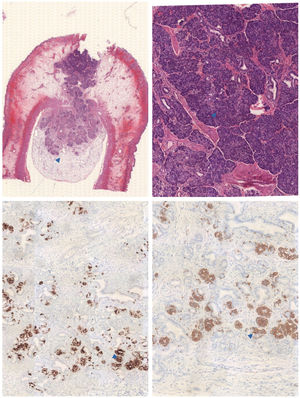 Estudio anatomopatológico. Superior izquierda: lesión transmural que se extiende desde la mucosa hasta la serosa intestinal, compuesta por conductos y acinos pancreáticos sin hallarse islotes de Langerhans. Superior derecha: a mayor aumento, se pueden observar los acinos pancreáticos compuestos por células poligonales sin atipia. Inferior: al realizarse pruebas de inmunohistoquímica, se evidencia celularidad positiva para marcadores neuroendocrinos como la cromogranina (izquierda) y la sinaptofisina (derecha).