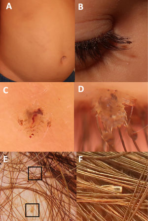 a) Máculas cerúleas en el tronco de un niño con pediculosis en el cuerpo. b) Liendres y piojos en las pestañas. c) Phthirus pubis sujeto de los vellos del tronco. d) El mismo parásito sujeto de las pestañas del paciente. e) Dentro de los cuadrados negros hay liendres viables. f) Liendres eclosionadas o no viables.