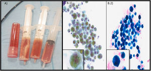 A) Imagen del líquido recuperado en el lavado broncoalveolar (3 jeringas) y en el aspirado bronquial (tubo). B.1) y B.2) Citologías a ×40 del lavado broncoalveolar donde se observan hemosiderófagos. B.1) Macrófagos con pigmento dorado en su interior que corresponde a hemosiderina. B.2) Tinción de Perls visualizándose macrófagos teñidos de azul (hierro de la hemosiderina).