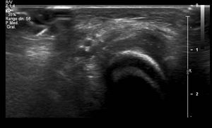 Ecografía de tobillo. Engrosamiento hipoecogénico del tejido celular subcutáneo en región de antepié, sin incremento de señal Doppler. Ecografía de tobillo. Engrosamiento hipoecogénico del tejido celular subcutáneo en región de antepié, sin incremento de señal Doppler.
