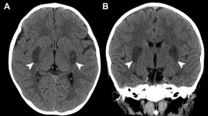 Imágenes de TC sin contraste axial (A) y coronal (B) que muestran hipodensidades simétricas bilaterales en los ganglios basales (puntas de flecha).