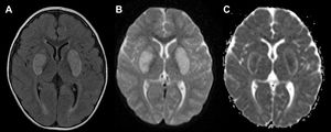 A)RM en corte axial en secuencia T2 FLAIR que muestra hiperintensidades simétricas bilaterales en los ganglios basales. B)Difusión restringida en imagen ponderada en difusión (DWI). C)El mapa ADC (coeficiente de difusión aparente) correspondiente revela un núcleo hipointenso central rodeado por un borde hiperintenso, compatible con encefalopatía necrosante aguda de la infancia.