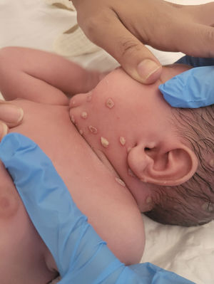 Lesiones vesiculosas y costrosas sobre fondo eritematoso en región preauricular y cervical izquierda, compatibles con distribución metamérica.