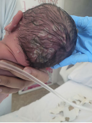 Afectación del cuero cabelludo con múltiples lesiones vesiculosas y costras sobre base eritematosa, de predominio en región occipital izquierda.