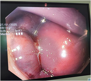 Imagen endoscópica: lesiones submucosas sobreelevadas de coloración violácea, protuyentes hacia la luz intestinal y condicionantes de una obstrucción parcial.