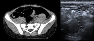 Imagen de TC: imágenes nodulares/polipoides dependientes de la pared endoluminal del colon izquierdo de hasta 3,5×2,5cm. Ecografía: engrosamiento mural del colon en la unión del colon sigmoide y descendente (la pared alcanza un espesor de 0,4cm) en posible relación con el hematoma referido.