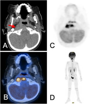 PET/CT con 18F-FDG-PET: realce intenso en el cóndilo occipital derecho extendiéndose hasta C1-C2, consistente con neoplasia maligna.