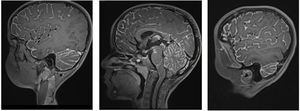 Secuencias de RMN en T1 con contraste en corte sagital que muestran realce leptomeníngeo difuso.