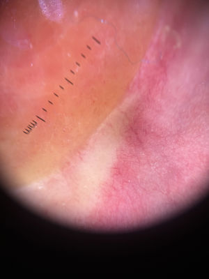Centro amarillo-anaranjado y halo eritematoso característicos del patrón en «sol poniente», con telangiectasias periféricas.