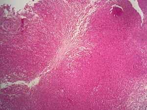 Hallazgos histológicos que muestran una epidermis ulcerada sobre un denso infiltrado histiocitario dérmico (tinción de hematoxilina-eosina, bajo aumento).