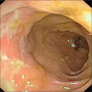 Ileítis terminal (enfermedad de Crohn).