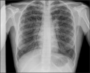 Radiografía con hiperinsuflación y afectación alvéolo-intersticial.