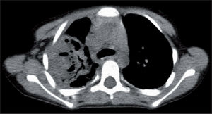Tomografía computarizada torácica: neumonía complicada, con empiema asociado y abscesos pulmonares.