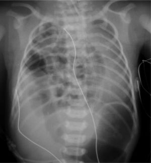 Hernia diafragmática congénita. La falta de cierre del diafragma produce, como consecuencia, la herniación de las visceras abdominales hacia el tórax y una hipoplasia pulmonar consecuente.