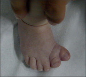 Polidactilia del primer dedo de los pies, con sindactilia de los dedos II-III, típicas del síndrome de Greig.